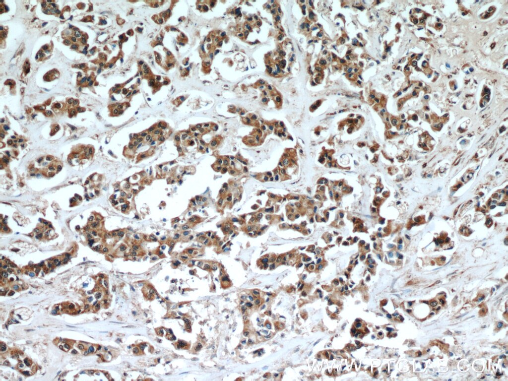 Immunohistochemistry (IHC) staining of human breast cancer tissue using SULT1A3 Polyclonal antibody (19499-1-AP)