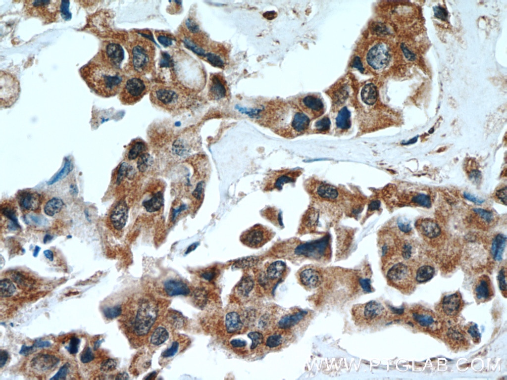 Immunohistochemistry (IHC) staining of human breast cancer tissue using SULT1A3 Polyclonal antibody (19499-1-AP)