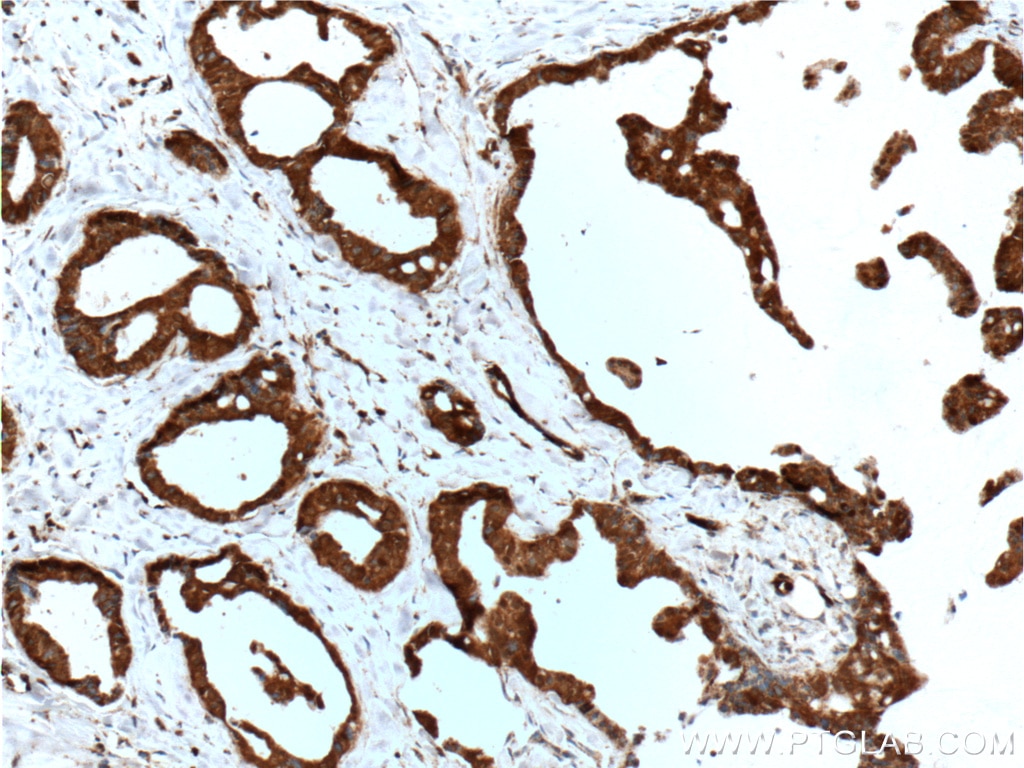 Immunohistochemistry (IHC) staining of human breast cancer tissue using SULT1A4 Polyclonal antibody (11376-1-AP)