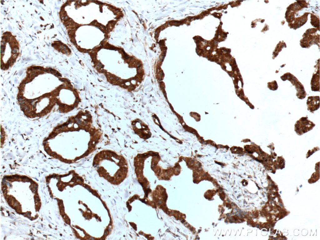 IHC staining of human breast cancer using 11376-1-AP