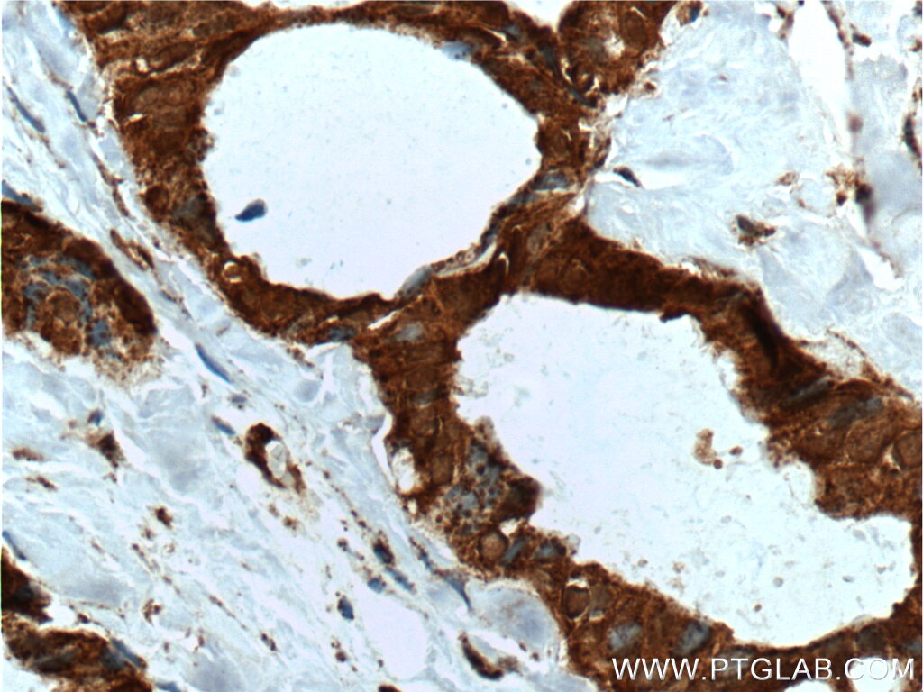 Immunohistochemistry (IHC) staining of human breast cancer tissue using SULT1A4 Polyclonal antibody (11376-1-AP)