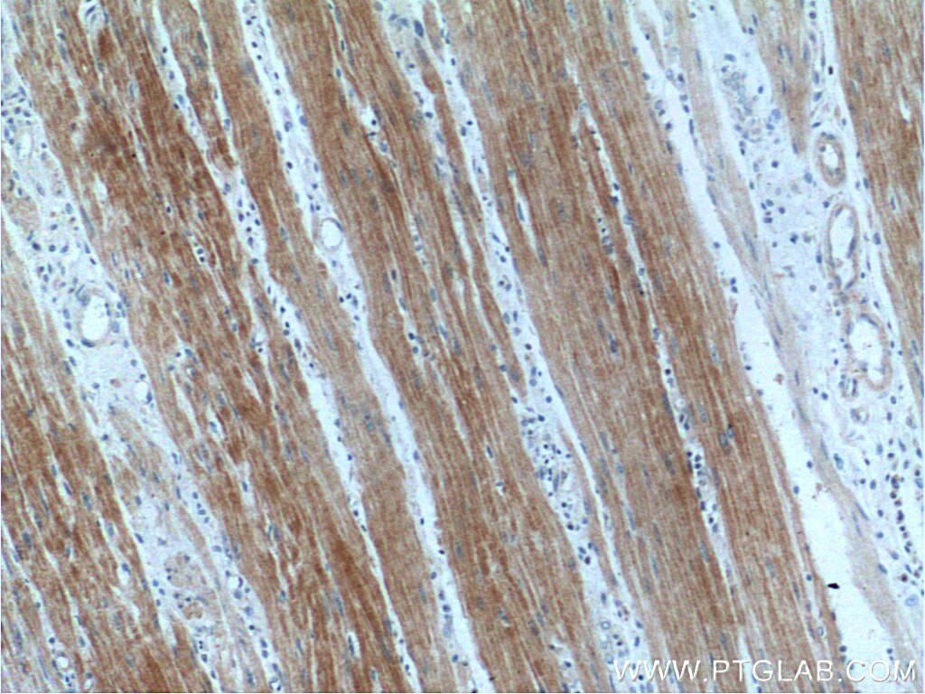 Immunohistochemistry (IHC) staining of human colon cancer tissue using SULT1B1 Polyclonal antibody (16050-1-AP)