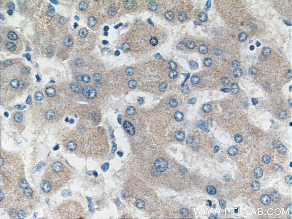 Immunohistochemistry (IHC) staining of human liver cancer tissue using SULT1B1 Polyclonal antibody (16050-1-AP)