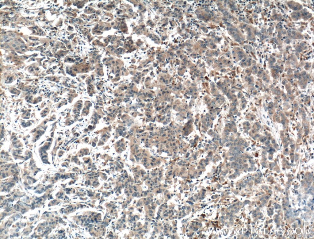 Immunohistochemistry (IHC) staining of human prostate cancer tissue using SULT1C2 Polyclonal antibody (10662-1-AP)