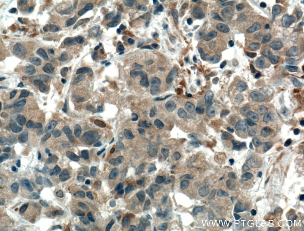 Immunohistochemistry (IHC) staining of human prostate cancer tissue using SULT1C2 Polyclonal antibody (10662-1-AP)