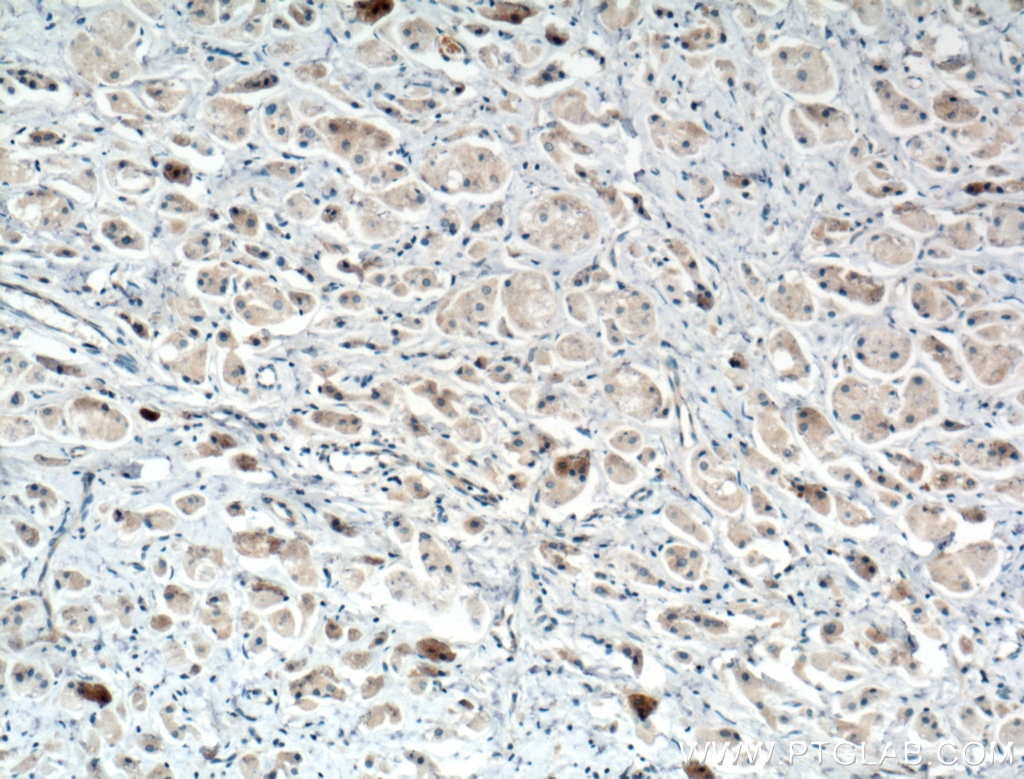 Immunohistochemistry (IHC) staining of human breast cancer tissue using SULT1E1 Polyclonal antibody (12522-1-AP)