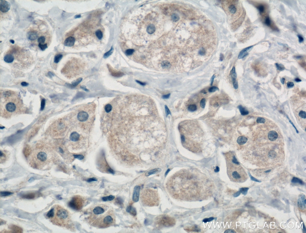 Immunohistochemistry (IHC) staining of human breast cancer tissue using SULT1E1 Polyclonal antibody (12522-1-AP)