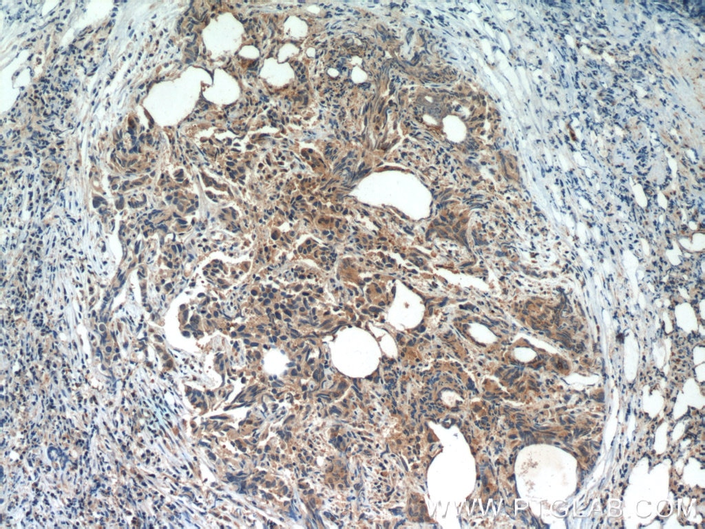 Immunohistochemistry (IHC) staining of human prostate cancer tissue using SULT2B1 Polyclonal antibody (12879-1-AP)