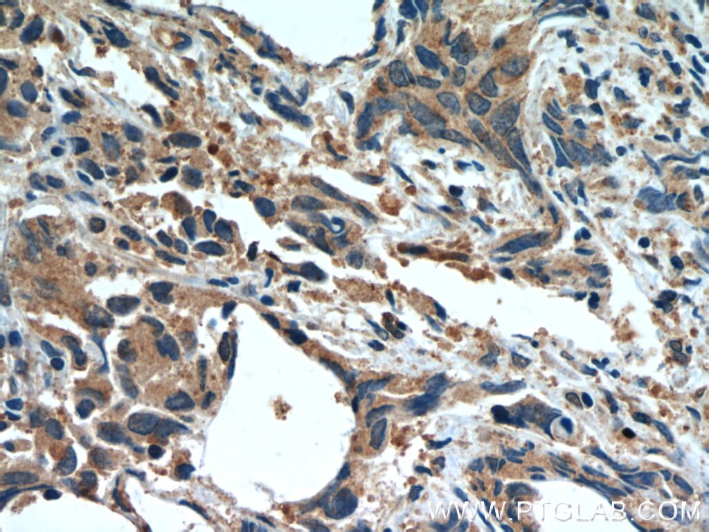Immunohistochemistry (IHC) staining of human prostate cancer tissue using SULT2B1 Polyclonal antibody (12879-1-AP)