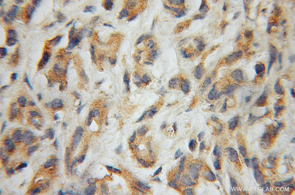 Immunohistochemistry (IHC) staining of human prostate cancer tissue using SULT2B1 Polyclonal antibody (12879-1-AP)