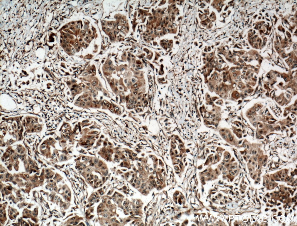 Immunohistochemistry (IHC) staining of human breast cancer tissue using SUMF2 Polyclonal antibody (11210-1-AP)