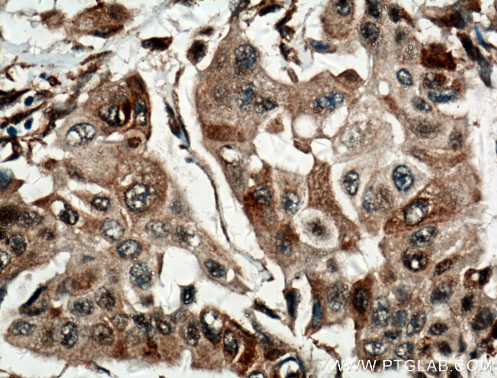 Immunohistochemistry (IHC) staining of human breast cancer tissue using SUMF2 Polyclonal antibody (11210-1-AP)