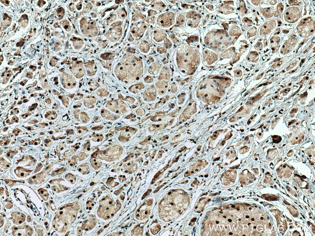 Immunohistochemistry (IHC) staining of human breast cancer tissue using SUMO2/3 Monoclonal antibody (67154-1-Ig)