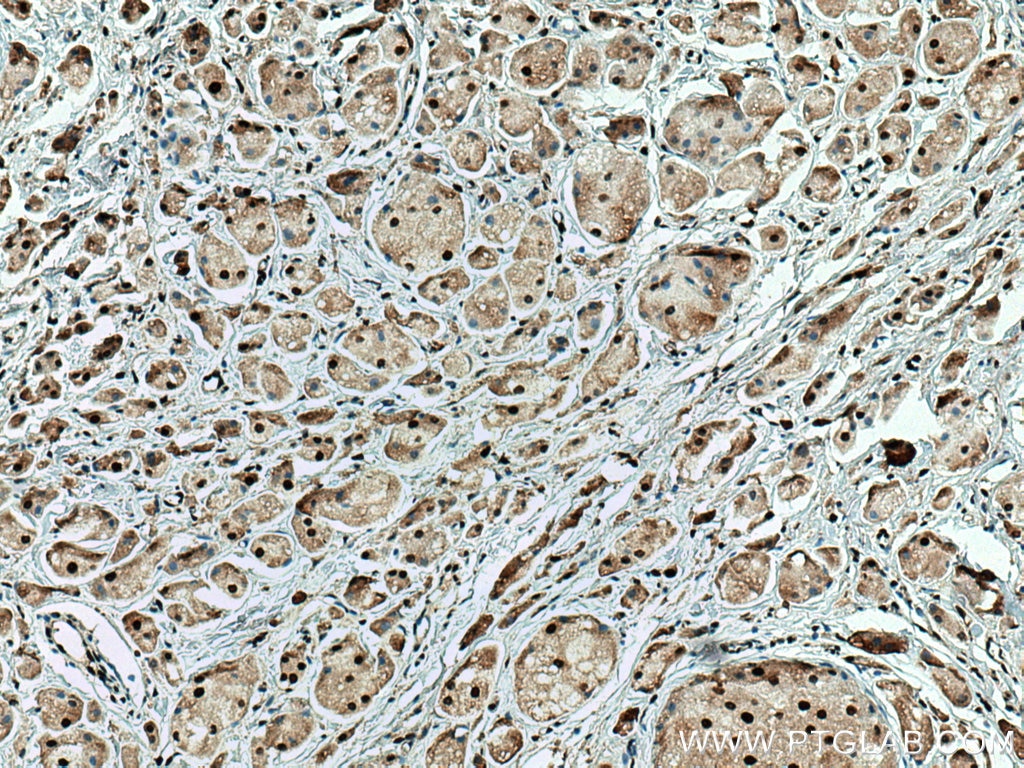 Immunohistochemistry (IHC) staining of human breast cancer tissue using SUMO2/3 Monoclonal antibody (67154-1-Ig)