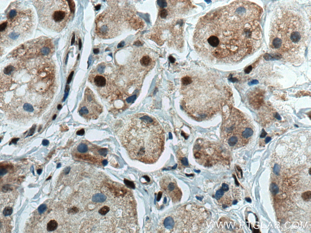 Immunohistochemistry (IHC) staining of human breast cancer tissue using SUMO2/3 Monoclonal antibody (67154-1-Ig)