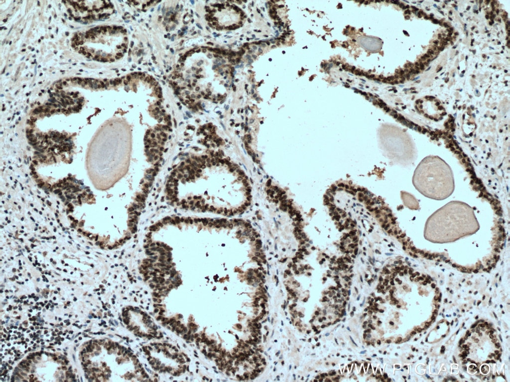 Immunohistochemistry (IHC) staining of human prostate cancer tissue using SUMO2/3 Monoclonal antibody (67154-1-Ig)