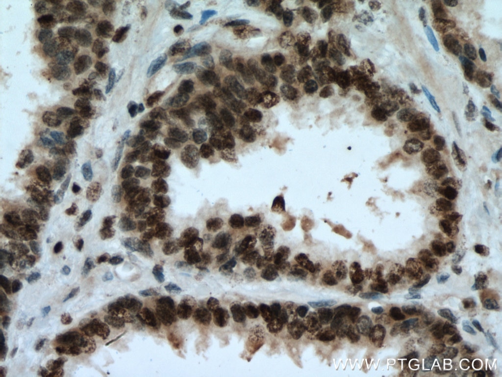 Immunohistochemistry (IHC) staining of human prostate cancer tissue using SUMO2/3 Monoclonal antibody (67154-1-Ig)