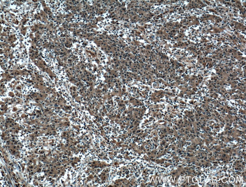 Immunohistochemistry (IHC) staining of human colon cancer tissue using SUMO2/3 Polyclonal antibody (10947-1-AP)