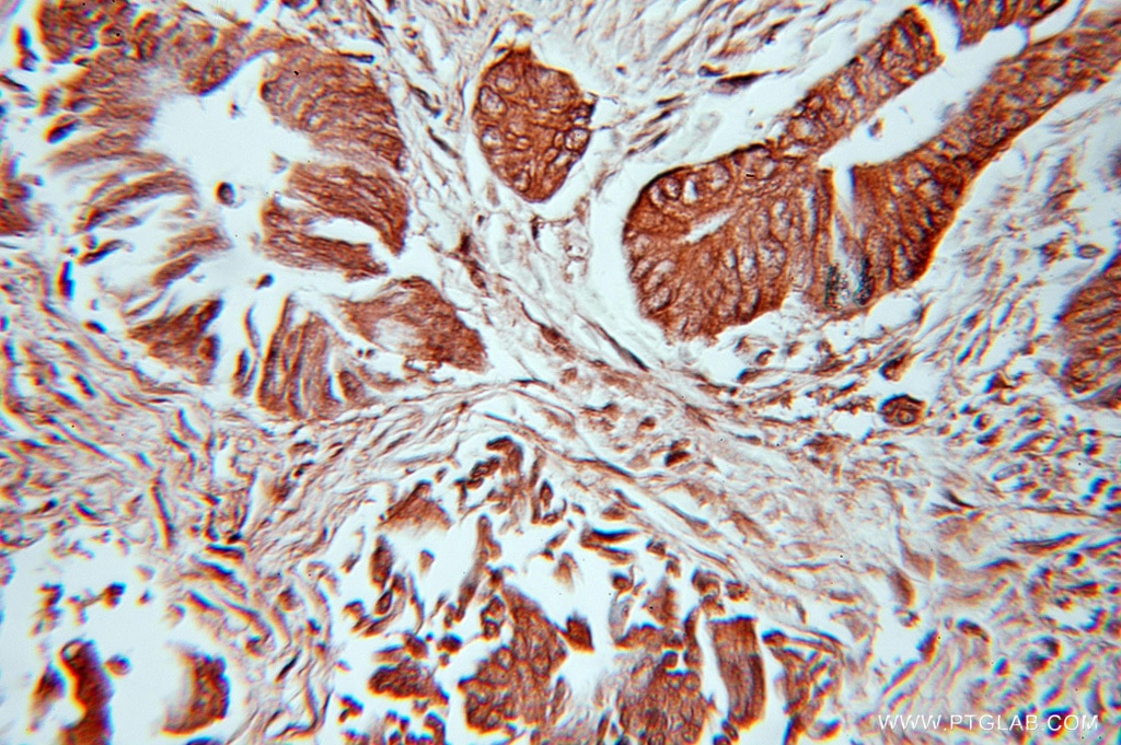 Immunohistochemistry (IHC) staining of human colon cancer tissue using SUMO2/3 Polyclonal antibody (10947-1-AP)