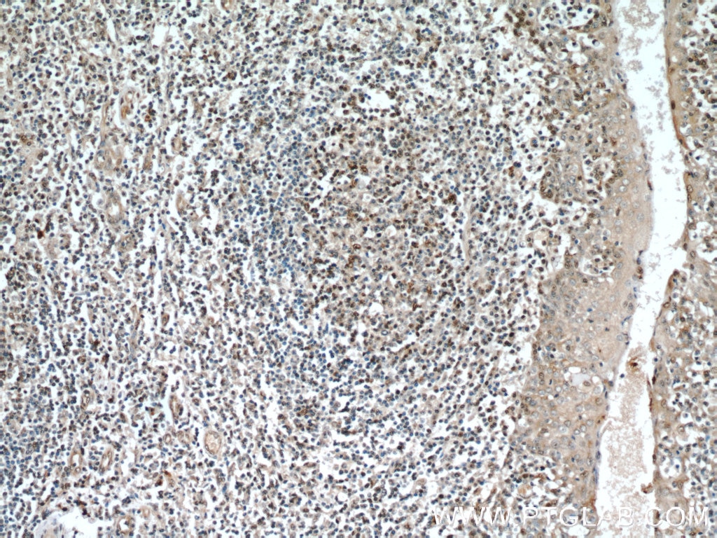 Immunohistochemistry (IHC) staining of human tonsillitis tissue using SUPT16H Polyclonal antibody (20551-1-AP)