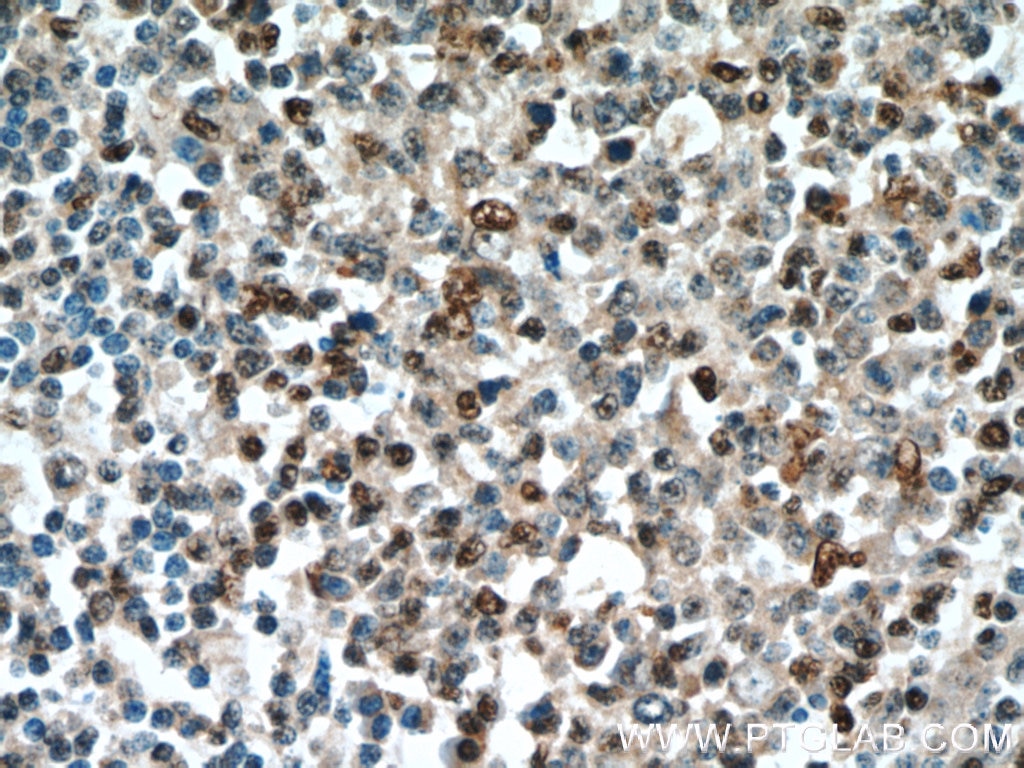 Immunohistochemistry (IHC) staining of human tonsillitis tissue using SUPT16H Polyclonal antibody (20551-1-AP)
