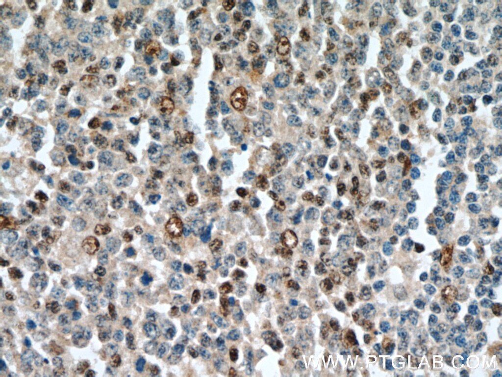 Immunohistochemistry (IHC) staining of human tonsillitis tissue using SUPT16H Polyclonal antibody (20551-1-AP)