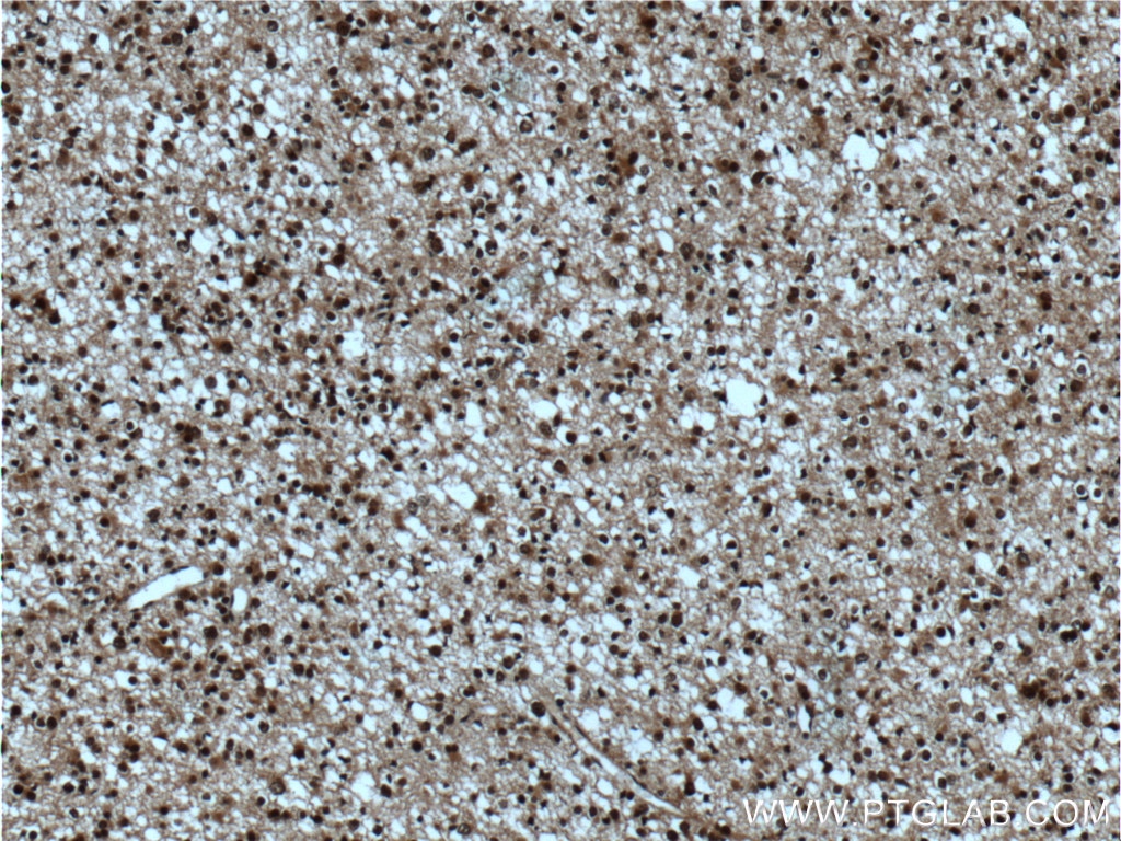 Immunohistochemistry (IHC) staining of human gliomas tissue using SUPT7L Polyclonal antibody (25606-1-AP)