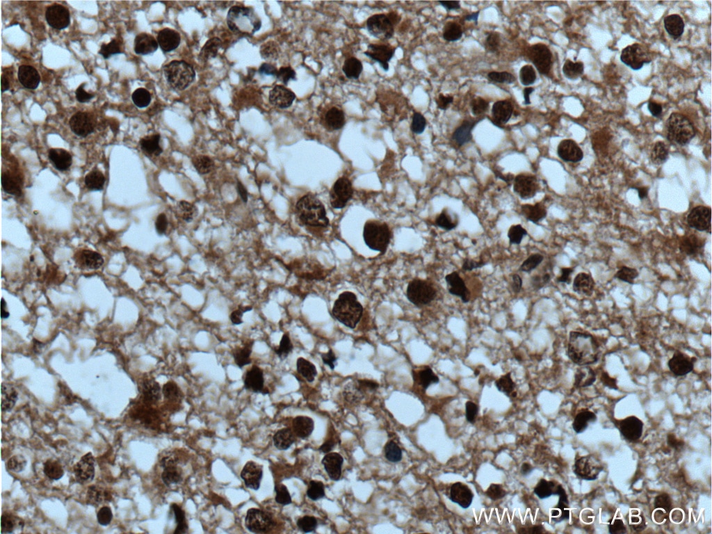 Immunohistochemistry (IHC) staining of human gliomas tissue using SUPT7L Polyclonal antibody (25606-1-AP)