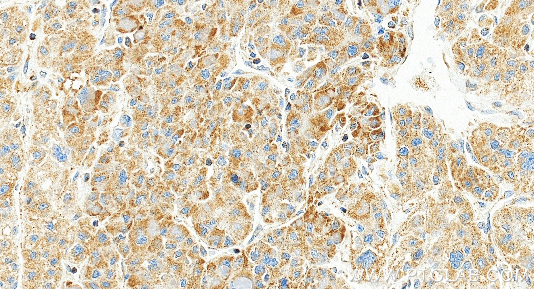 Immunohistochemistry (IHC) staining of human liver cancer tissue using SUPV3L1 Recombinant monoclonal antibody (86706-1-RR)