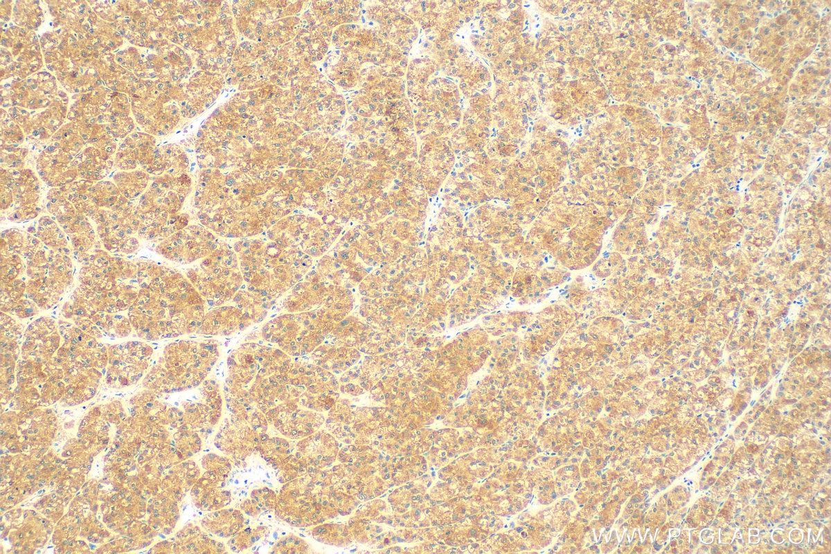 Immunohistochemistry (IHC) staining of human liver cancer tissue using SURF1 Recombinant antibody (83052-5-RR)
