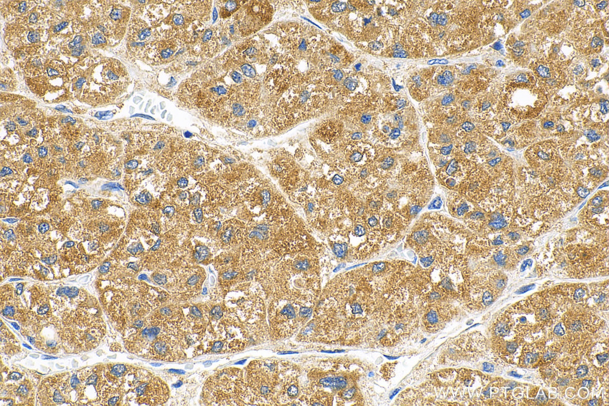 IHC staining of human liver cancer using 83052-5-RR