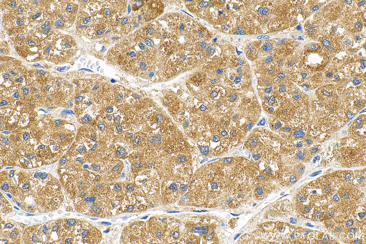 Immunohistochemistry (IHC) staining of human liver cancer tissue using SURF1 Recombinant antibody (83052-5-RR)