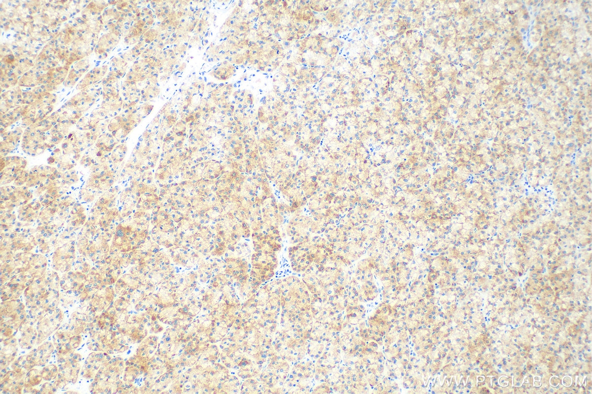 IHC staining of human liver cancer using 83052-7-RR