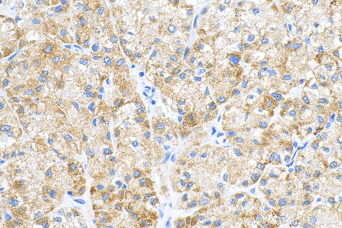 IHC staining of human liver cancer using 83052-7-RR