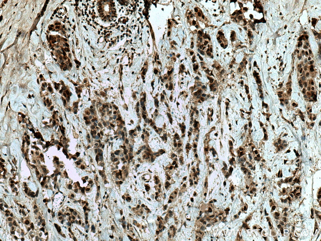 Immunohistochemistry (IHC) staining of human breast cancer tissue using SURF2 Polyclonal antibody (16522-1-AP)