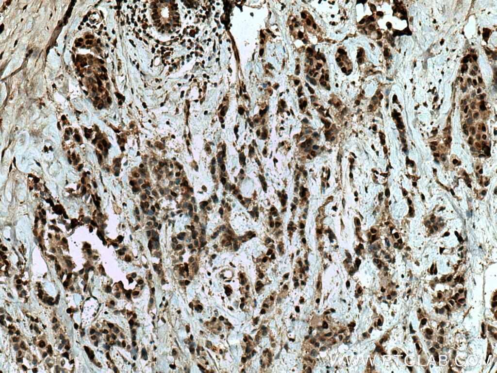 IHC staining of human breast cancer using 16522-1-AP