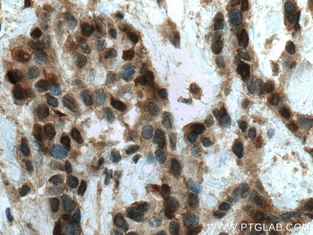Immunohistochemistry (IHC) staining of human breast cancer tissue using SURF2 Polyclonal antibody (16522-1-AP)