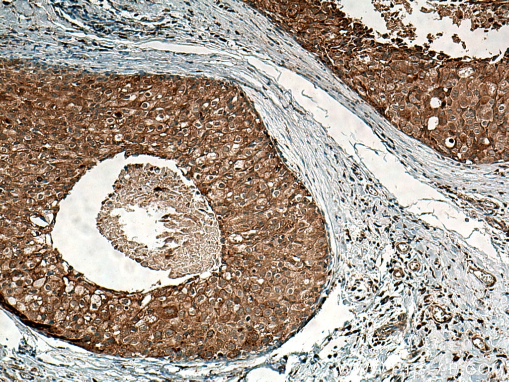 Immunohistochemistry (IHC) staining of human breast cancer tissue using SURF4 Polyclonal antibody (11599-1-AP)