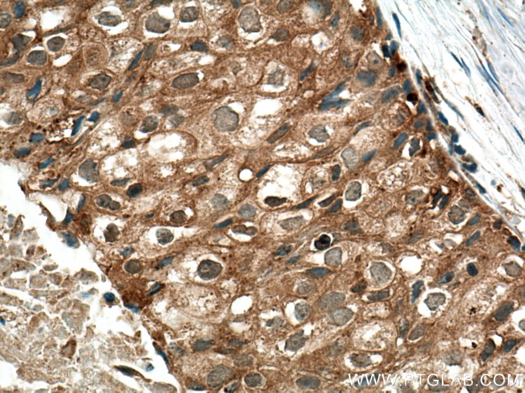 Immunohistochemistry (IHC) staining of human breast cancer tissue using SURF4 Polyclonal antibody (11599-1-AP)