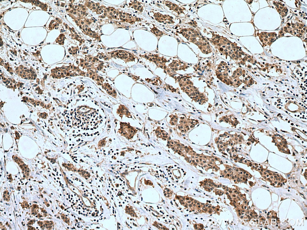 IHC staining of human breast cancer using 10508-1-AP