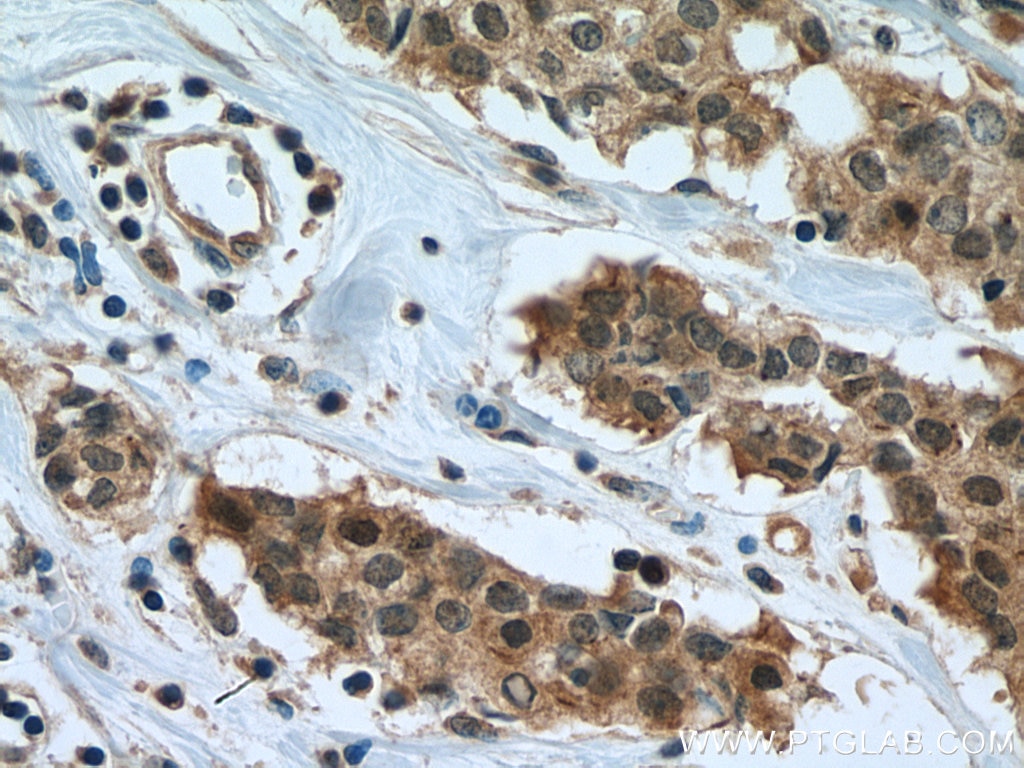 Immunohistochemistry (IHC) staining of human breast cancer tissue using SURVIVIN Polyclonal antibody (10508-1-AP)