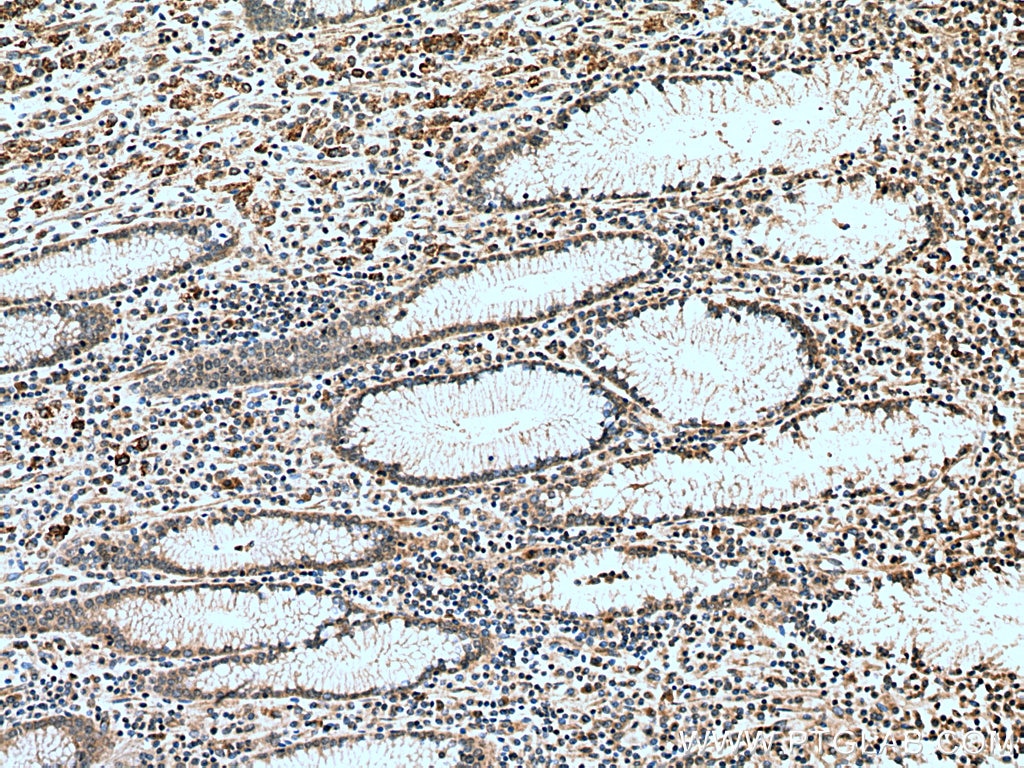 Immunohistochemistry (IHC) staining of human stomach cancer tissue using SURVIVIN Polyclonal antibody (10508-1-AP)