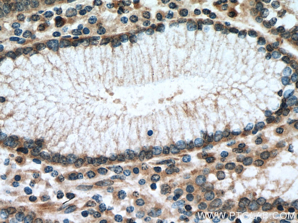 Immunohistochemistry (IHC) staining of human stomach cancer tissue using SURVIVIN Polyclonal antibody (10508-1-AP)