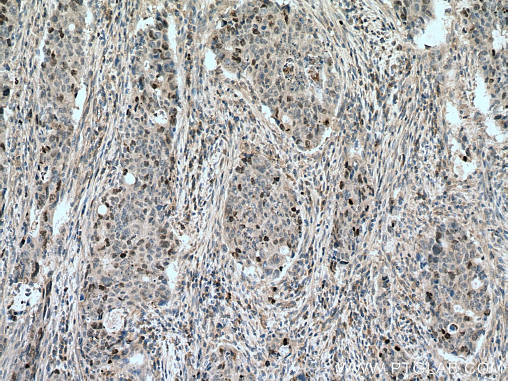 Immunohistochemistry (IHC) staining of human colon cancer tissue using SURVIVIN Polyclonal antibody (10508-1-AP)