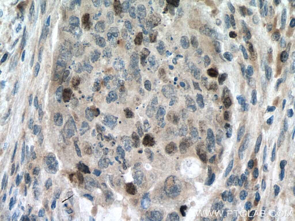 Immunohistochemistry (IHC) staining of human colon cancer tissue using SURVIVIN Polyclonal antibody (10508-1-AP)