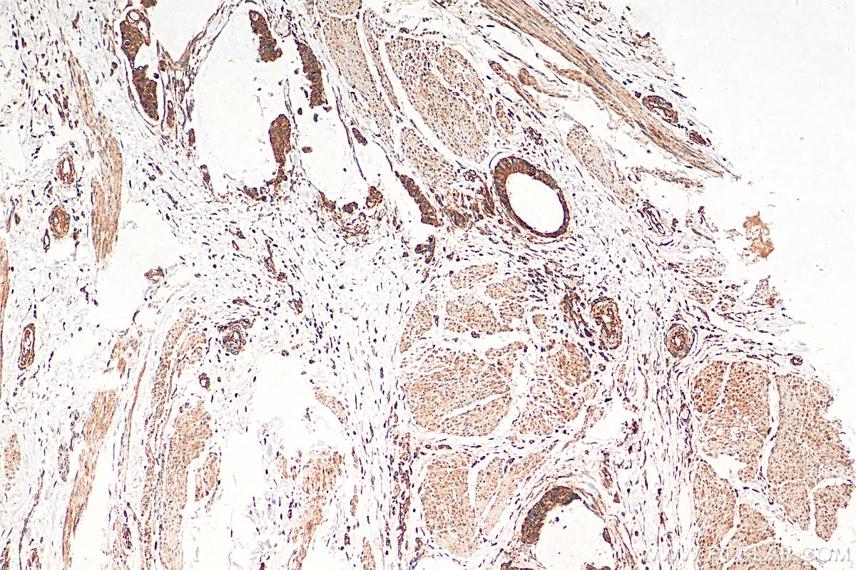 IHC staining of human urothelial carcinoma using 10508-1-AP