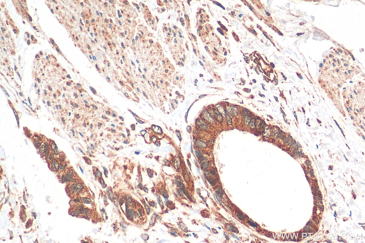 Immunohistochemistry (IHC) staining of human urothelial carcinoma tissue using SURVIVIN Polyclonal antibody (10508-1-AP)