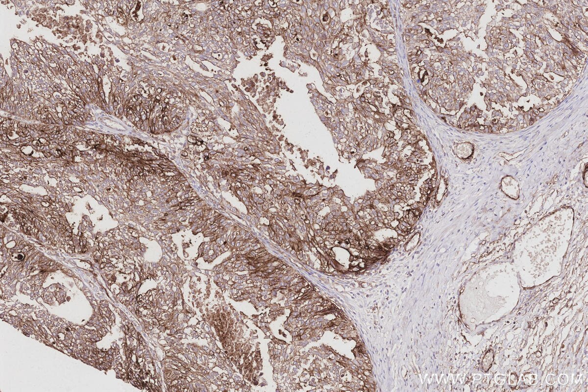 Immunohistochemistry (IHC) staining of human ovary cancer tissue using SUSD2 Polyclonal antibody (30711-1-AP)