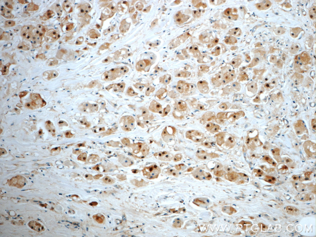 Immunohistochemistry (IHC) staining of human breast cancer tissue using SUZ12 Polyclonal antibody (20366-1-AP)