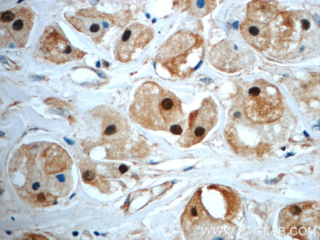 Immunohistochemistry (IHC) staining of human breast cancer tissue using SUZ12 Polyclonal antibody (20366-1-AP)